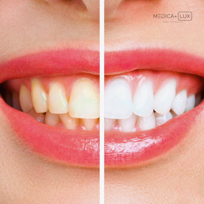 Гель для відбілювання Medica+ WhitePearl Pengel 3X фото № 7